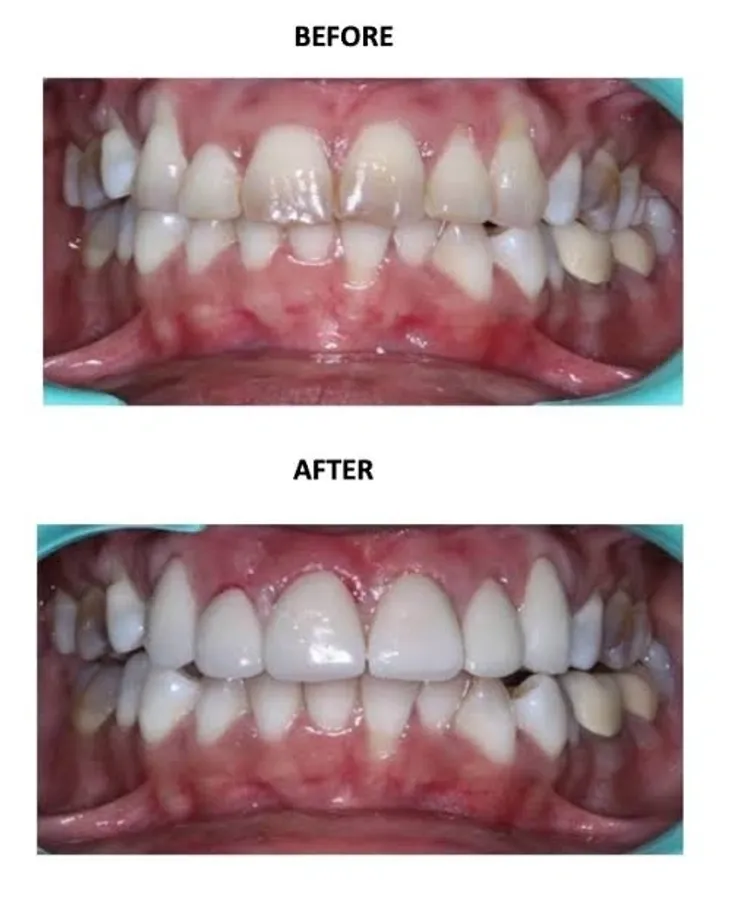 Dental veneers Bangalore