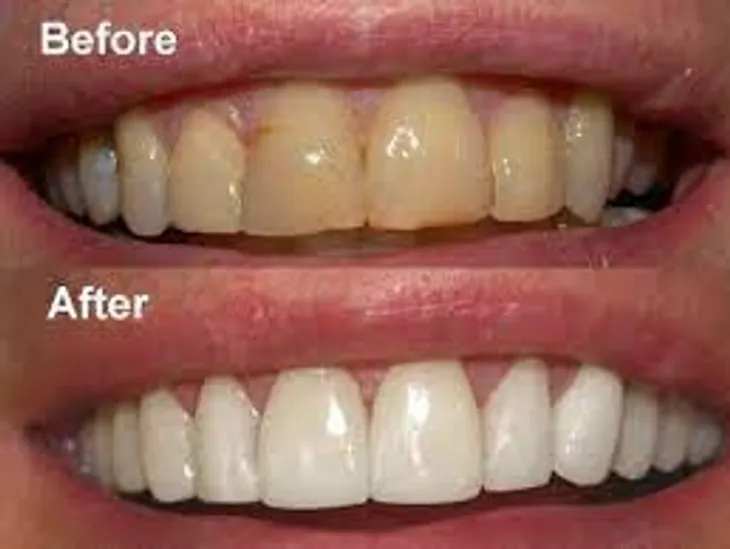 Teeth whitening Bangalore