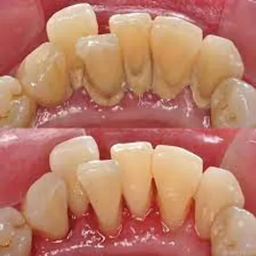 Teeth scaling and cleaning Bangalore