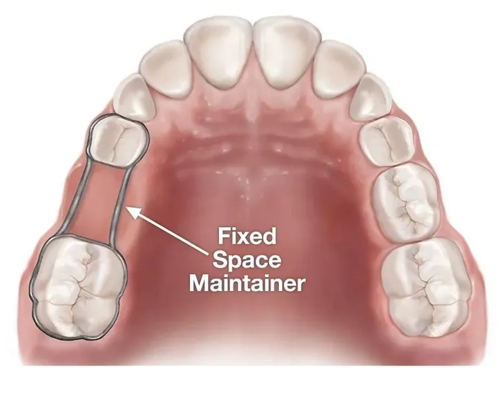 Space maintainer for children missing baby tooth