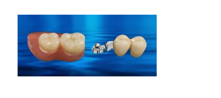 Precision attachment dentures