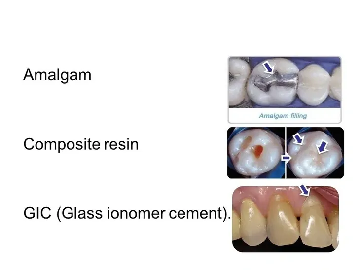 Dental restorations composite GIC amalgam